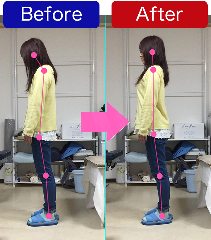 姿勢解析　立位側面比較