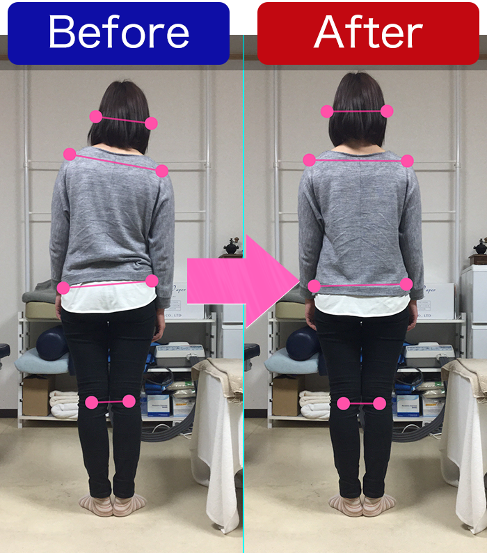 姿勢解析　立位背面比較
